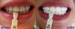 laser-teeth-whitening-2